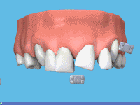 Procedimiento de colocación de brackets cerámicos en Dr. G Dental Studio Miami